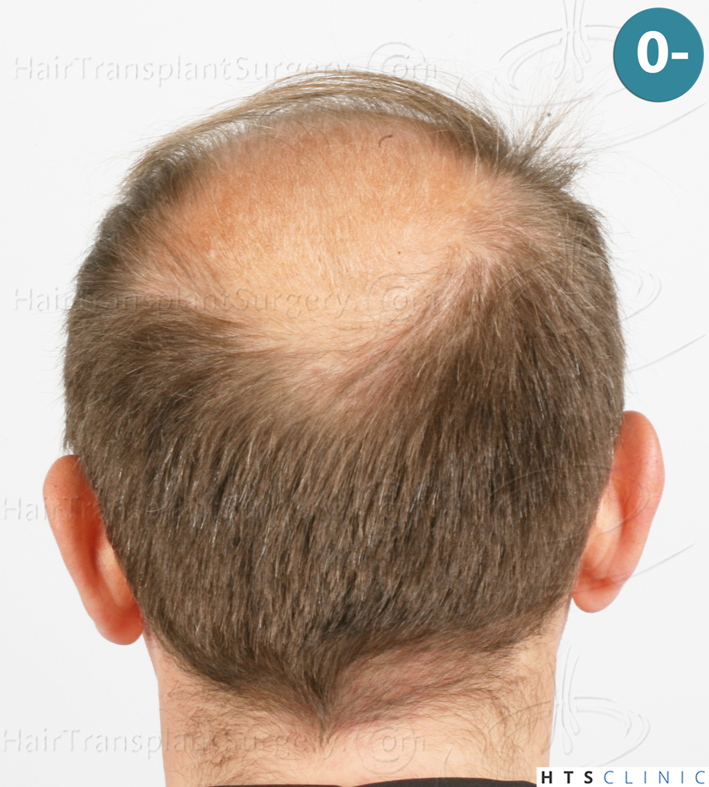 Dr.Devroye-HTS-Clinic-2238-FUE-5