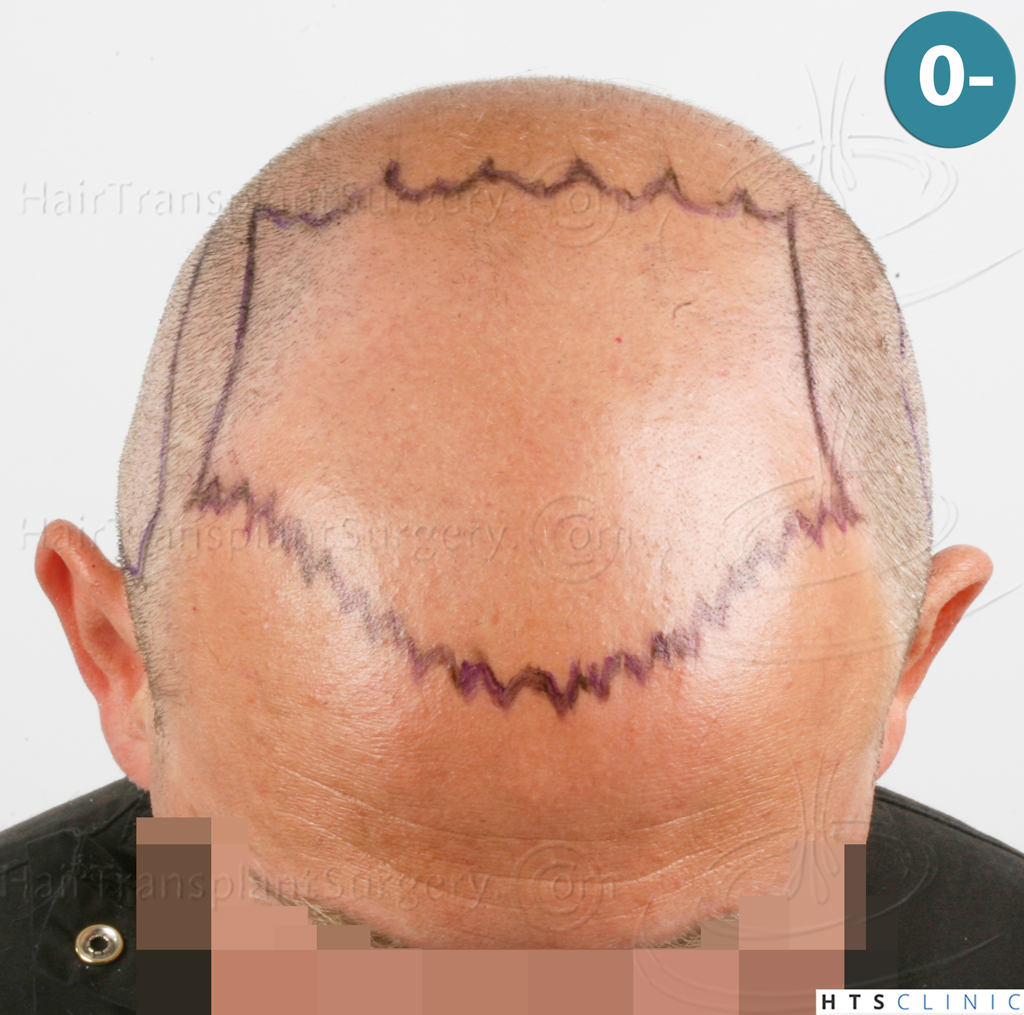 Dr.Devroye-HTS-Clinic-2238-FUE-7