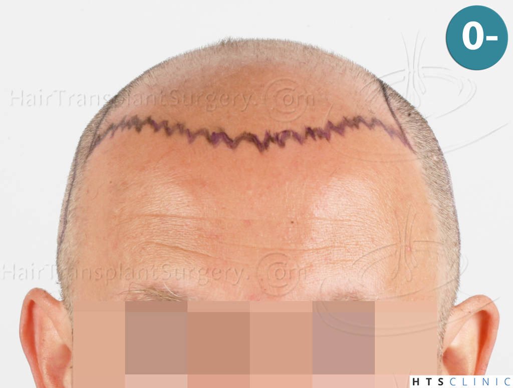 Dr.Devroye-HTS-Clinic-2238-FUE-8