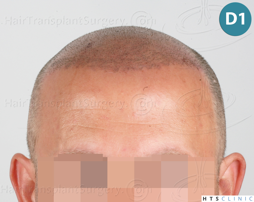 Dr.Devroye-HTS-Clinic-2238-FUE-11