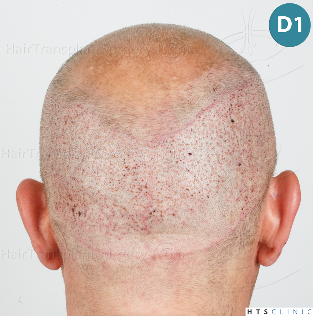 Dr.Devroye-HTS-Clinic-2238-FUE-13