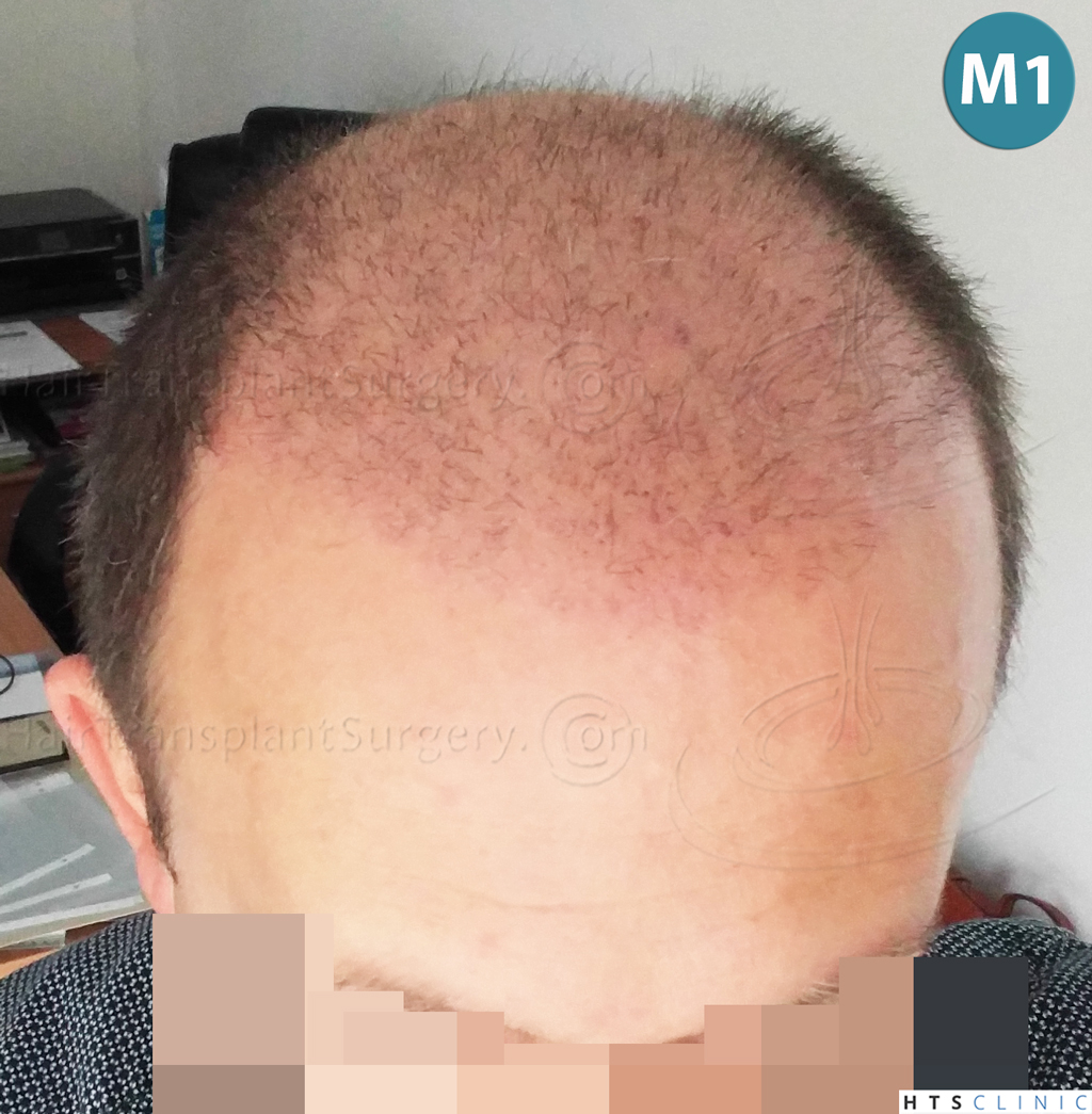 Dr.Devroye-HTS-Clinic-2238-FUE-15