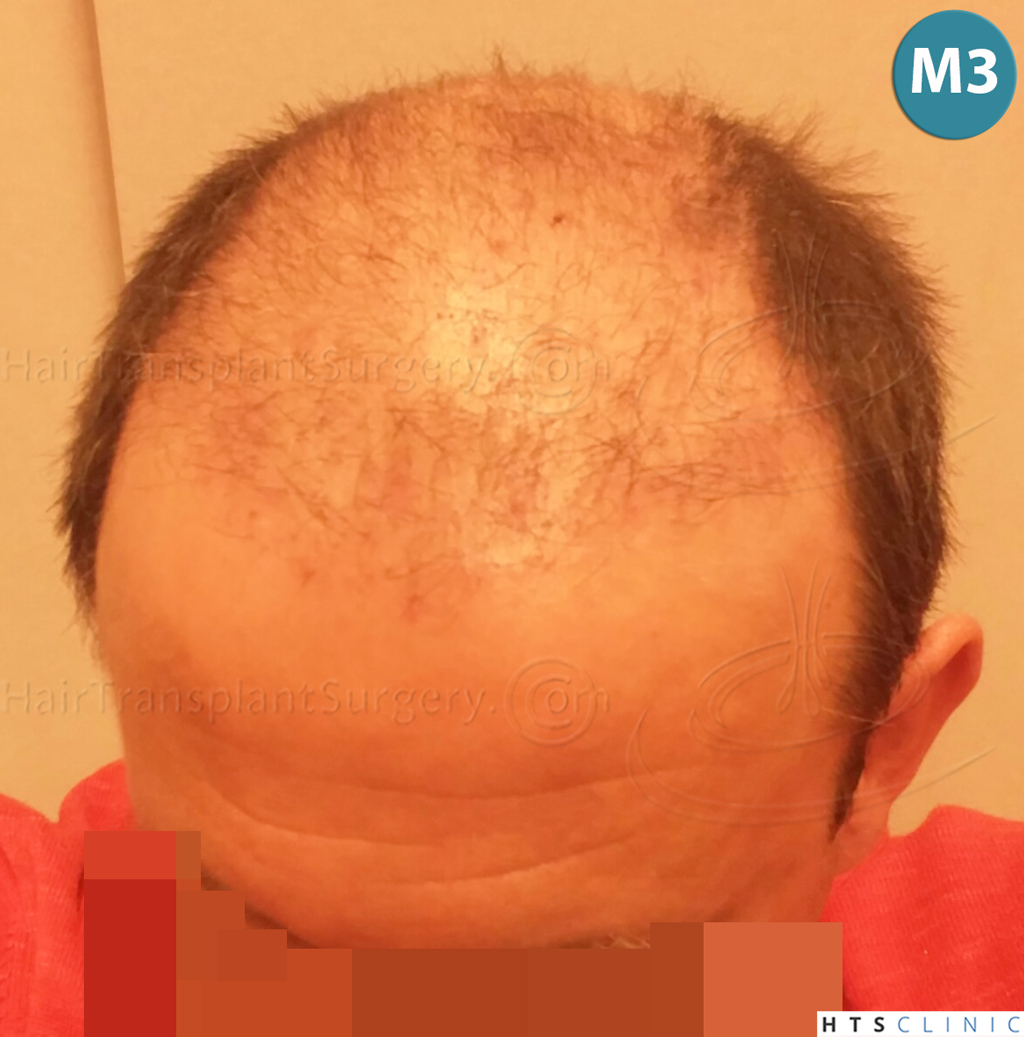 Dr.Devroye-HTS-Clinic-2238-FUE-16