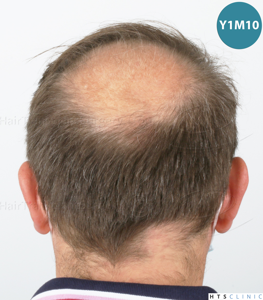 Dr.Devroye-HTS-Clinic-2238-FUE-21