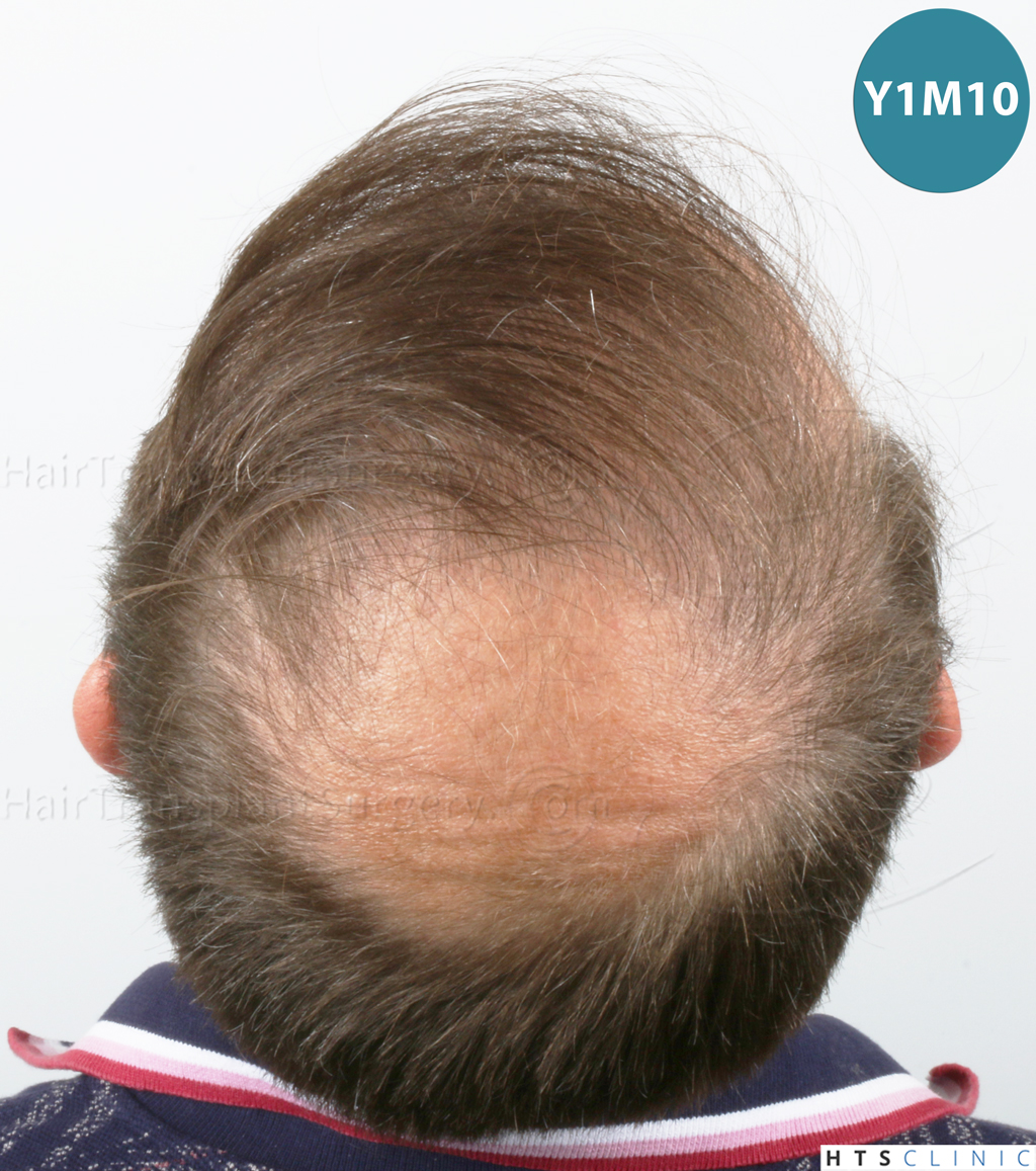 Dr.Devroye-HTS-Clinic-2238-FUE-22