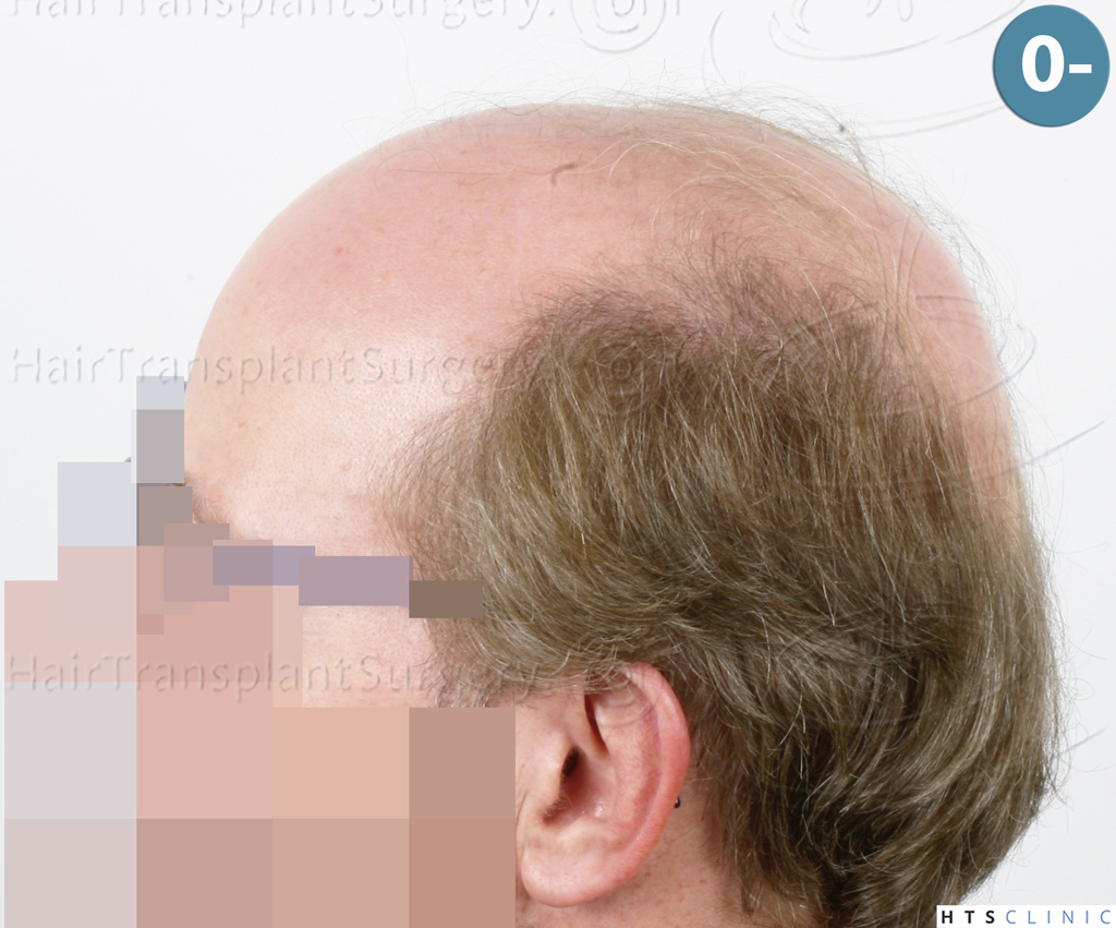 Dr.Devroye-HTS-Clinic-6494-FUE-BHT-NW-VI