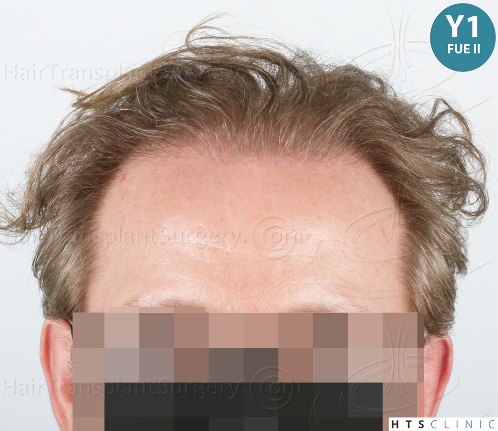 Dr.Devroye-HTS-Clinic-6494-FUE-BHT-NW-VI