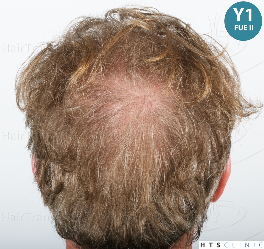 Dr.Devroye-HTS-Clinic-6494-FUE-BHT-NW-VII-44.jpg