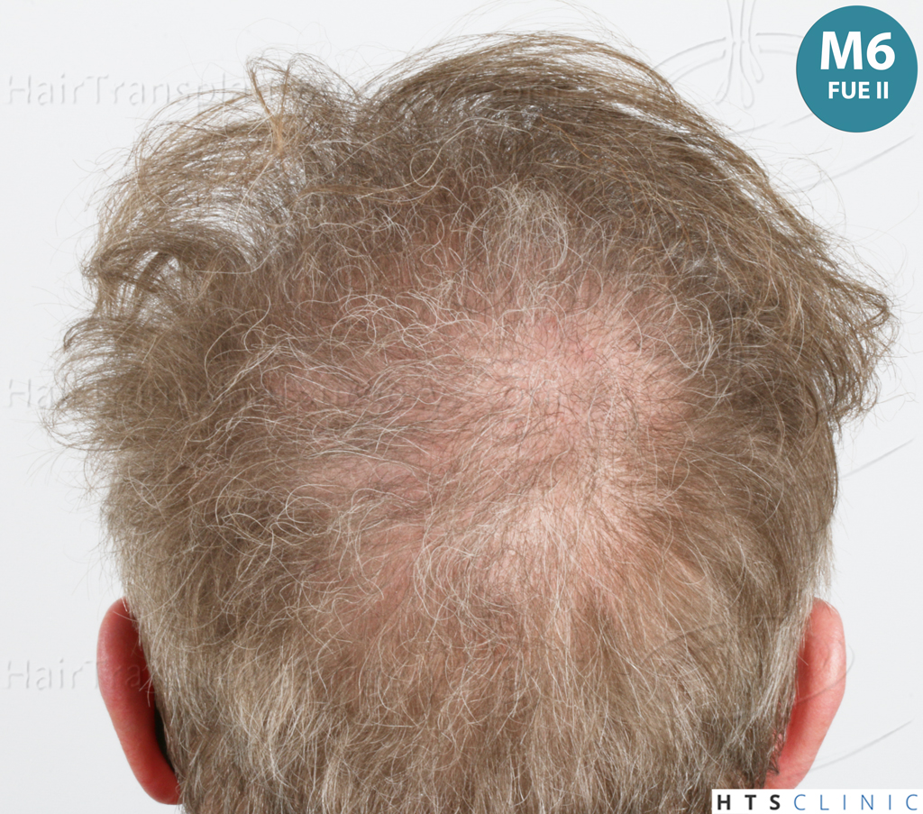 Dr.Devroye-HTS-Clinic-6494-FUE-BHT-NW-VI