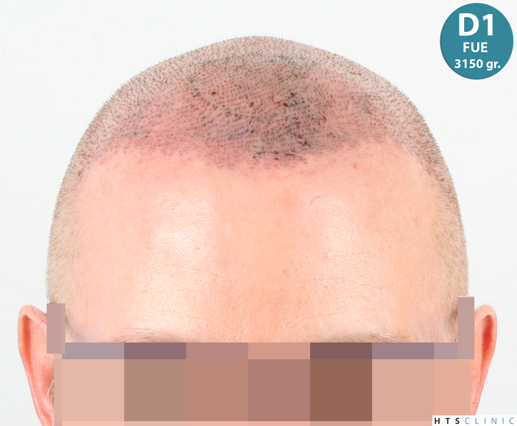 Dr.Devroye-HTS-Clinic-6494-FUE-BHT-NW-VI