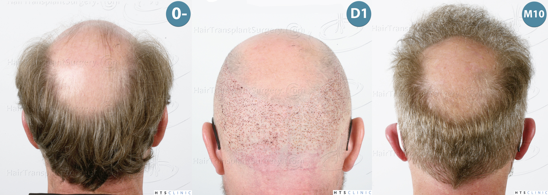 Dr.Devroye-HTS-Clinic-6494-FUE-BHT-NW-VI