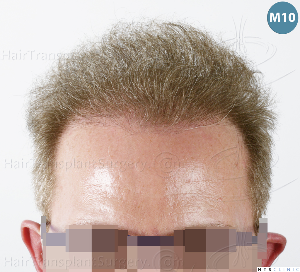 Dr.Devroye-HTS-Clinic-6494-FUE-BHT-NW-VI