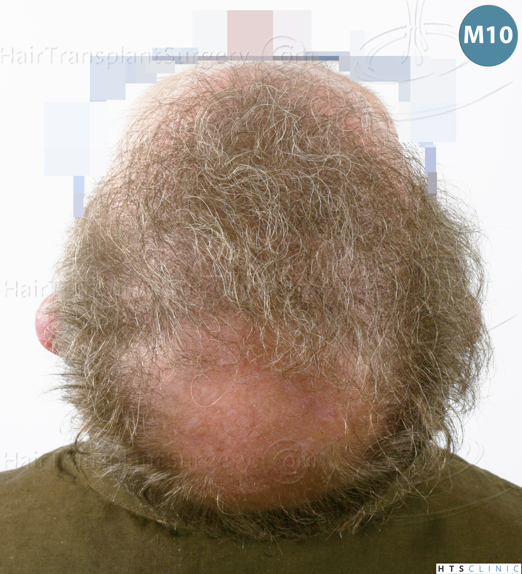 Dr.Devroye-HTS-Clinic-6494-FUE-BHT-NW-VI