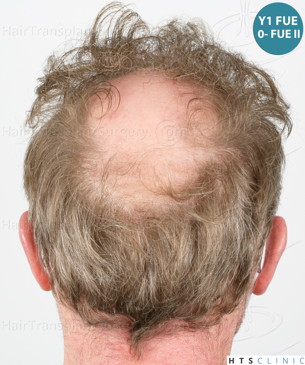 Dr.Devroye-HTS-Clinic-6494-FUE-BHT-NW-VI