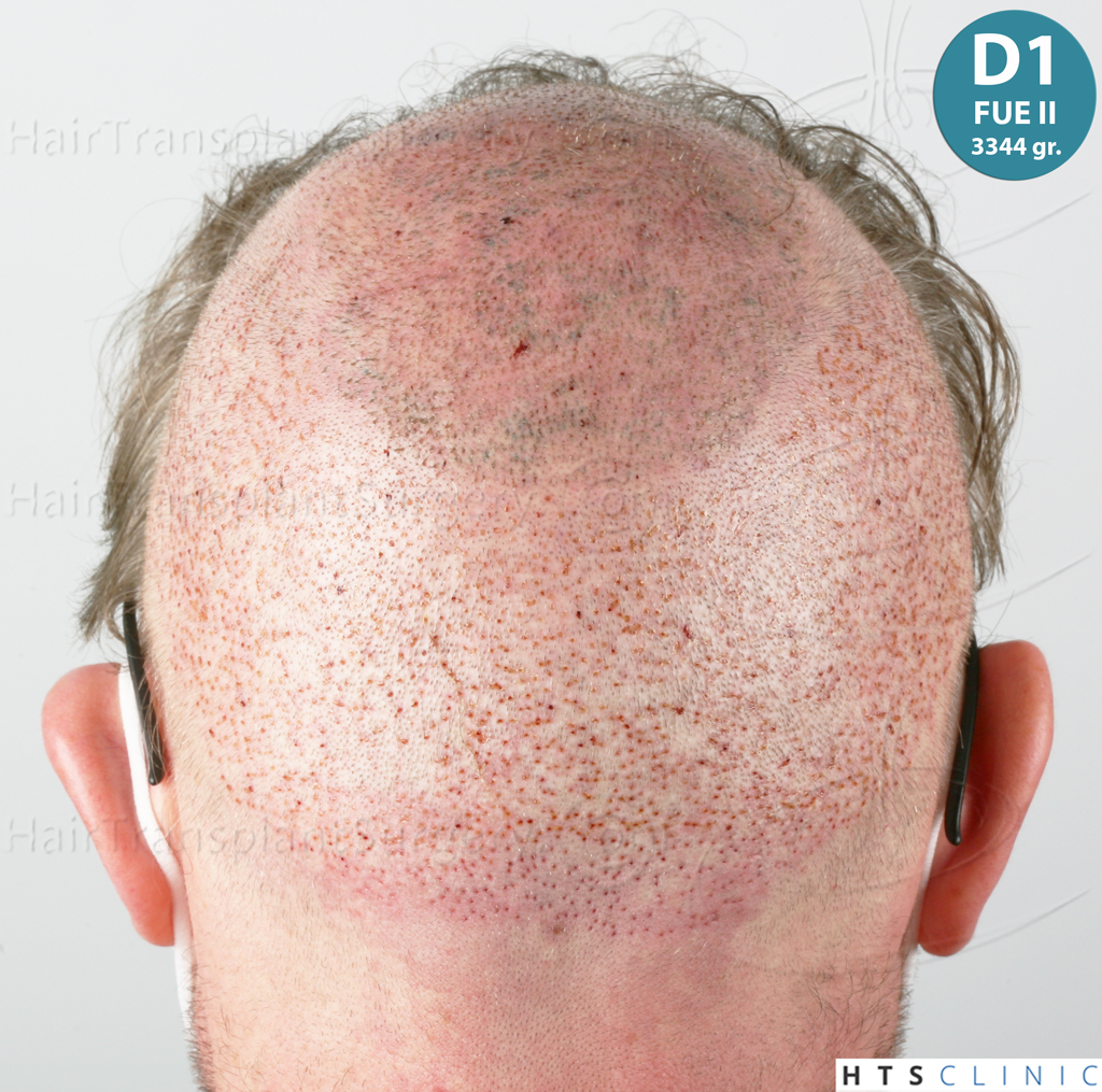 Dr.Devroye-HTS-Clinic-6494-FUE-BHT-NW-VI