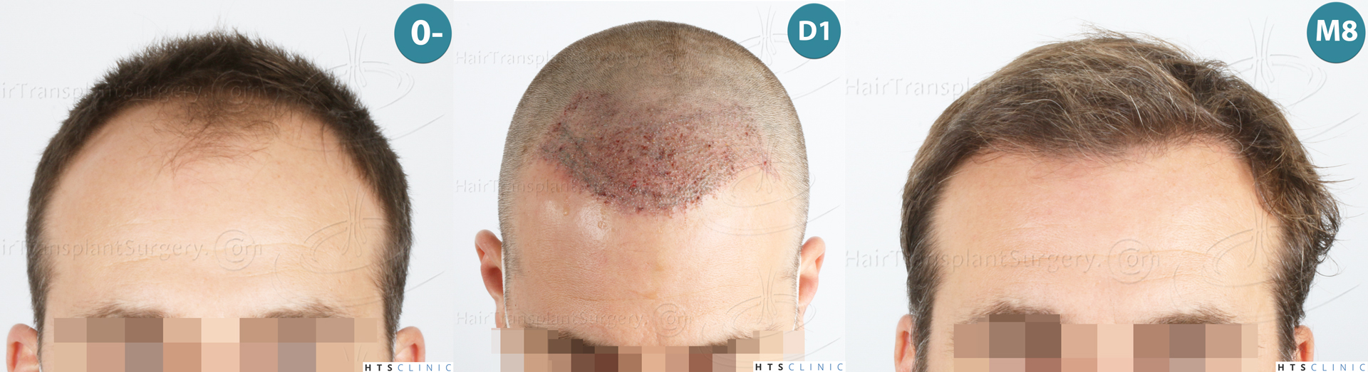 Dr.Devroye-HTS-Clinic-2007-FUE-NW-IVA-Mo Dr.Devroye-HTS-Clinic-2007-FUE-NW-IVA-Mo