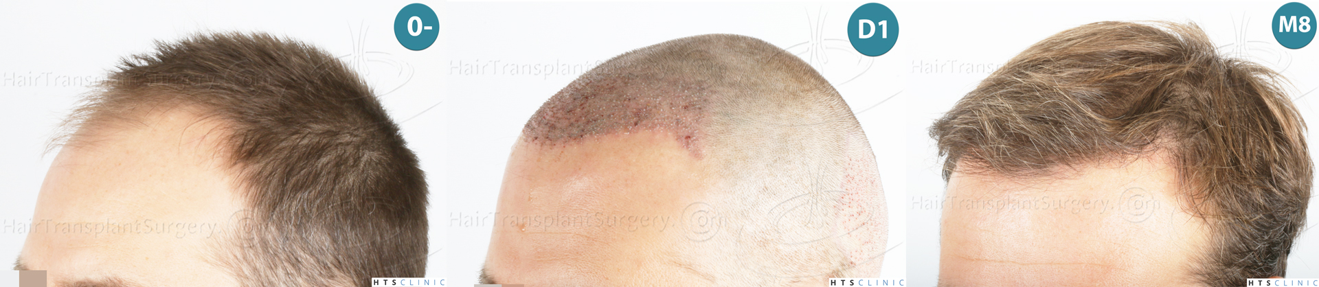 Dr.Devroye-HTS-Clinic-2007-FUE-NW-IVA-Mo Dr.Devroye-HTS-Clinic-2007-FUE-NW-IVA-Mo
