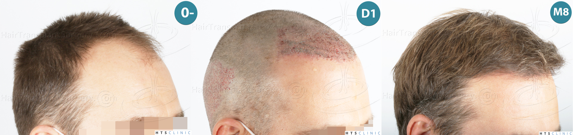 Dr.Devroye-HTS-Clinic-2007-FUE-NW-IVA-Mo Dr.Devroye-HTS-Clinic-2007-FUE-NW-IVA-Mo