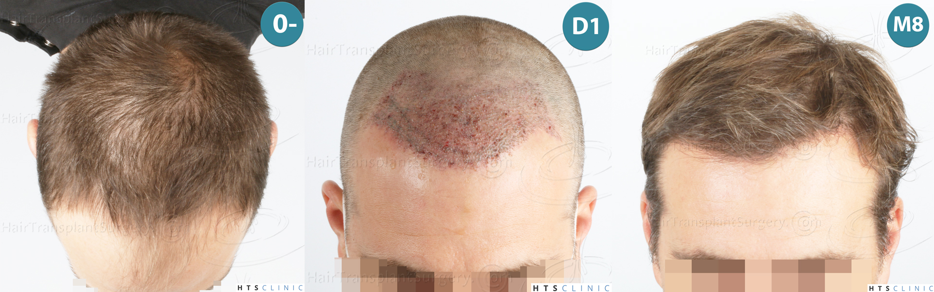 Dr.Devroye-HTS-Clinic-2007-FUE-NW-IVA-Mo Dr.Devroye-HTS-Clinic-2007-FUE-NW-IVA-Mo
