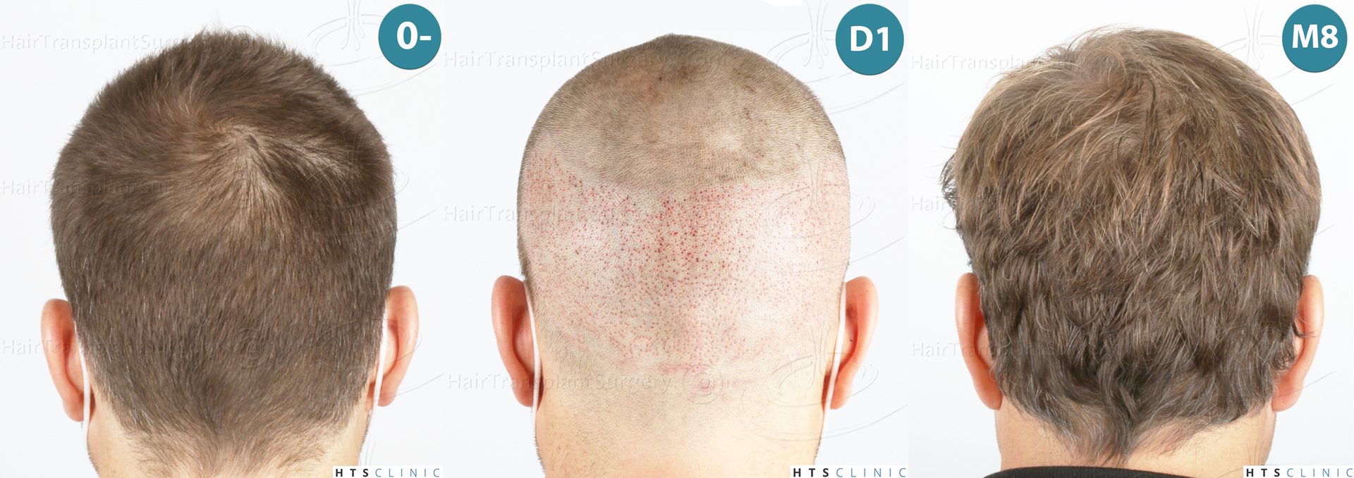 Dr.Devroye-HTS-Clinic-2007-FUE-NW-IVA-Mo Dr.Devroye-HTS-Clinic-2007-FUE-NW-IVA-Mo