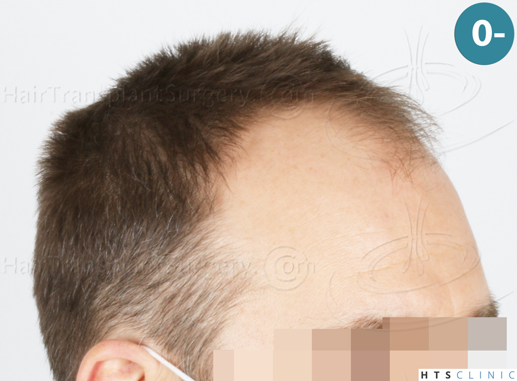 Dr.Devroye-HTS-Clinic-2007-FUE-NW-IVA-5. Dr.Devroye-HTS-Clinic-2007-FUE-NW-IVA-5.