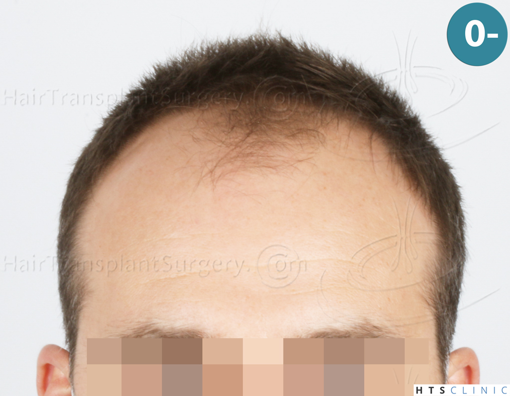 Dr.Devroye-HTS-Clinic-2007-FUE-NW-IVA-1. Dr.Devroye-HTS-Clinic-2007-FUE-NW-IVA-1.