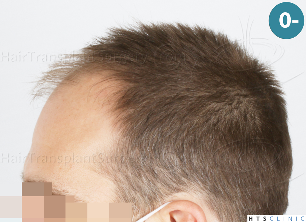 Dr.Devroye-HTS-Clinic-2007-FUE-NW-IVA-2. Dr.Devroye-HTS-Clinic-2007-FUE-NW-IVA-2.