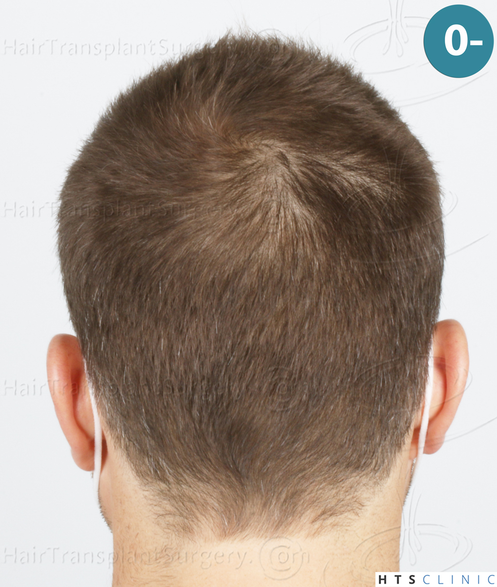 Dr.Devroye-HTS-Clinic-2007-FUE-NW-IVA-6. Dr.Devroye-HTS-Clinic-2007-FUE-NW-IVA-6.