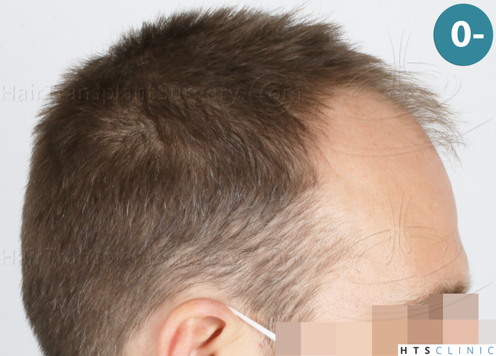Dr.Devroye-HTS-Clinic-2007-FUE-NW-IVA-4. Dr.Devroye-HTS-Clinic-2007-FUE-NW-IVA-4.