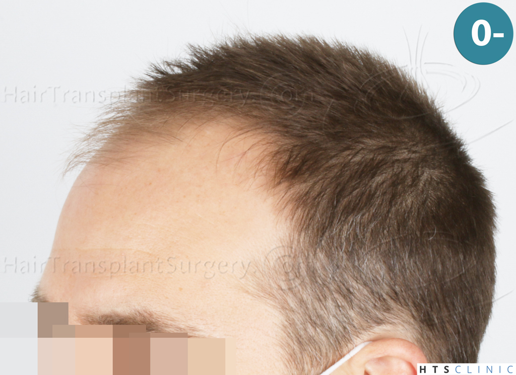 Dr.Devroye-HTS-Clinic-2007-FUE-NW-IVA-3. Dr.Devroye-HTS-Clinic-2007-FUE-NW-IVA-3.
