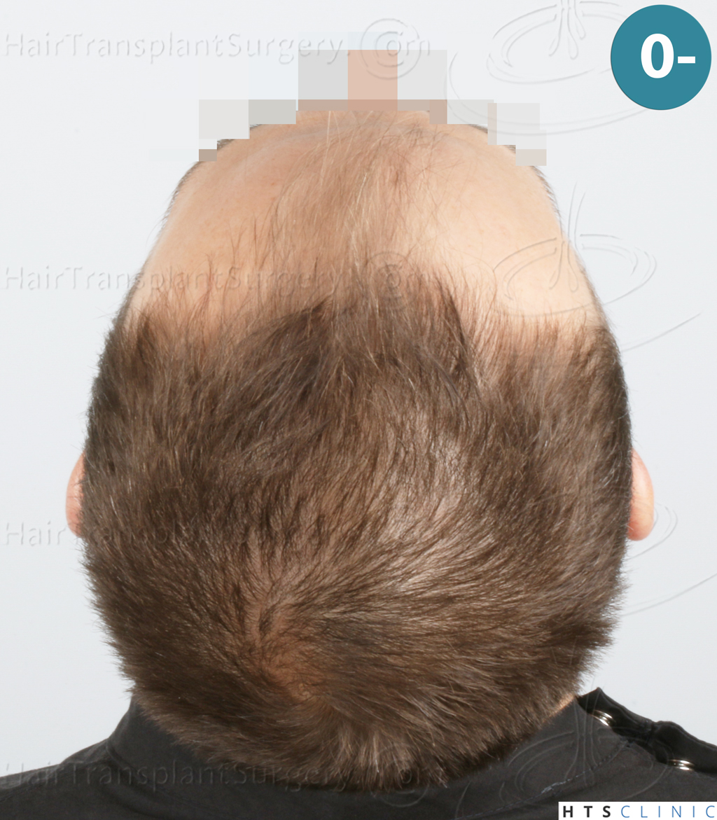 Dr.Devroye-HTS-Clinic-2007-FUE-NW-IVA-7. Dr.Devroye-HTS-Clinic-2007-FUE-NW-IVA-7.