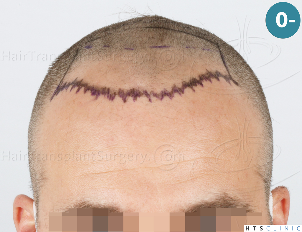 Dr.Devroye-HTS-Clinic-2007-FUE-NW-IVA-8. Dr.Devroye-HTS-Clinic-2007-FUE-NW-IVA-8.