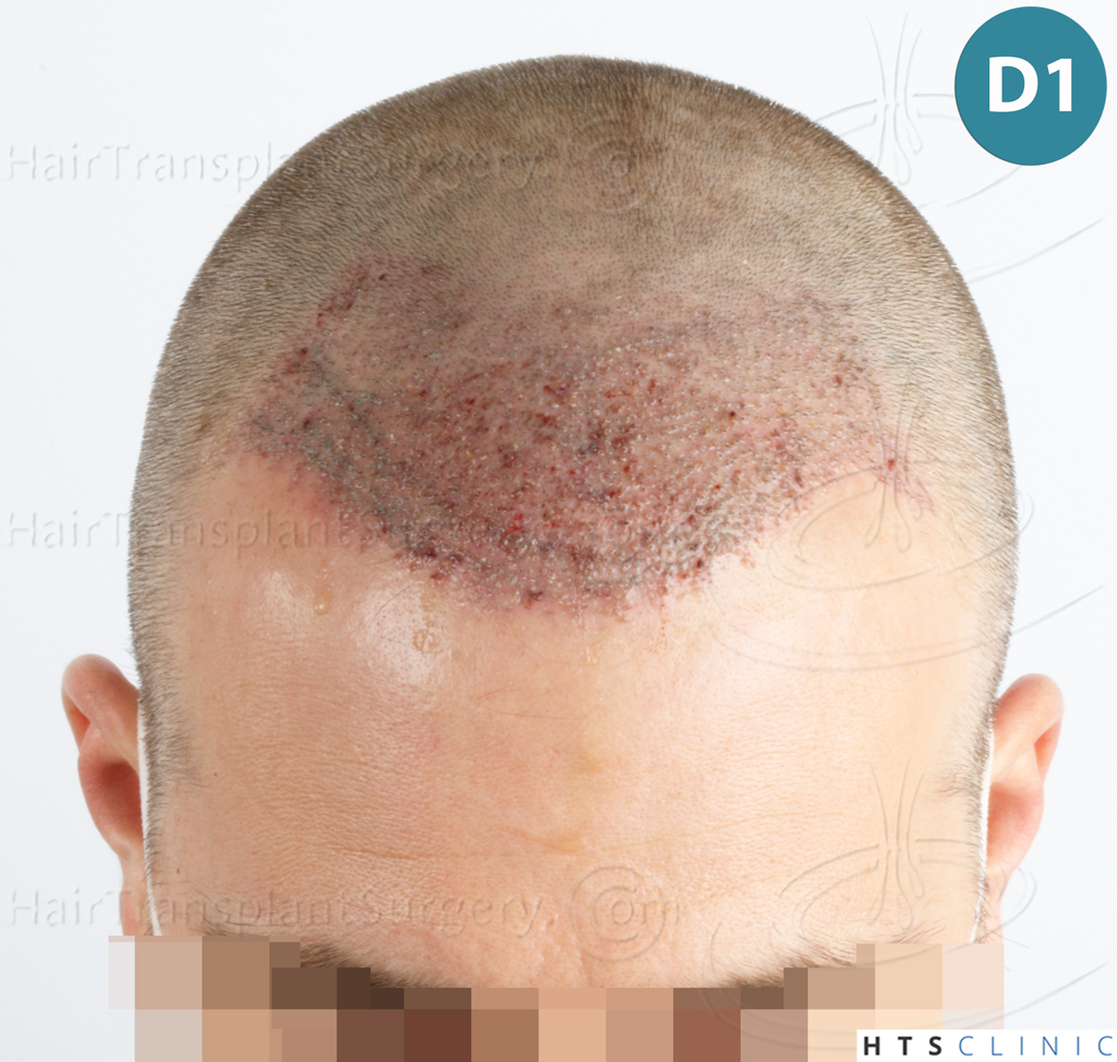 Dr.Devroye-HTS-Clinic-2007-FUE-NW-IVA-9. Dr.Devroye-HTS-Clinic-2007-FUE-NW-IVA-9.
