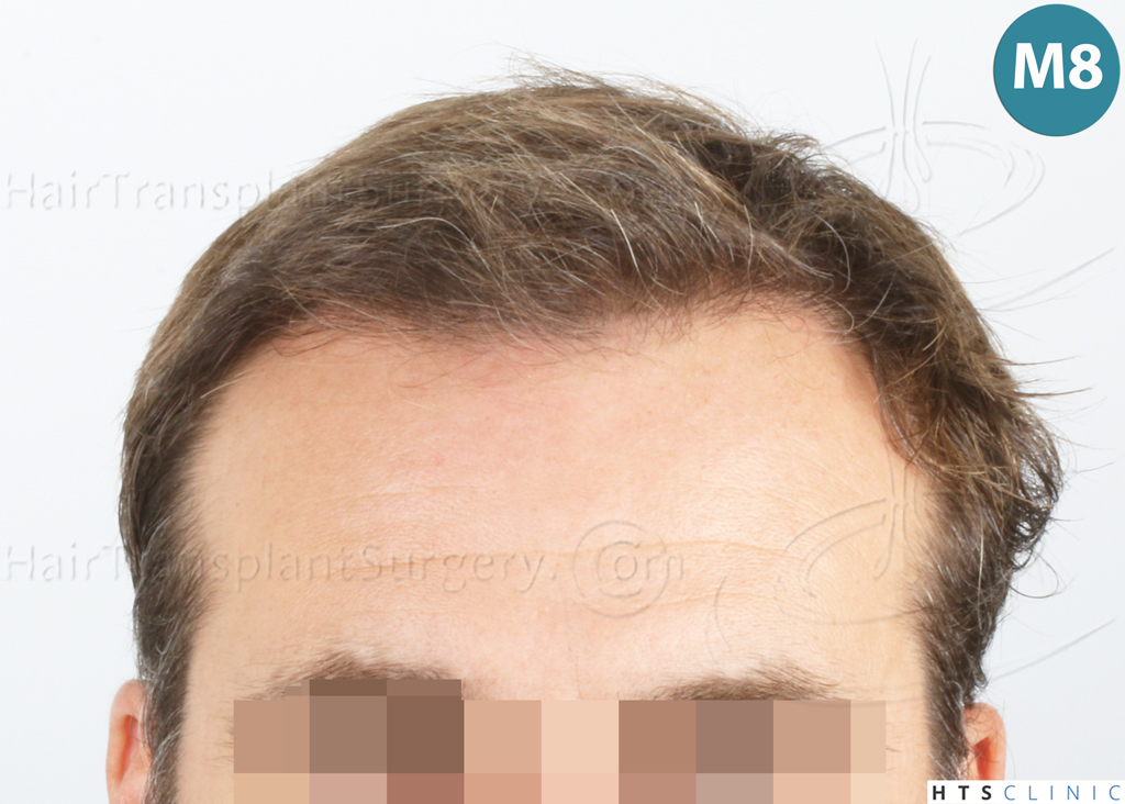 Dr.Devroye-HTS-Clinic-2007-FUE-NW-IVA-16 Dr.Devroye-HTS-Clinic-2007-FUE-NW-IVA-16