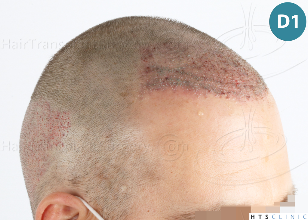 Dr.Devroye-HTS-Clinic-2007-FUE-NW-IVA-11 Dr.Devroye-HTS-Clinic-2007-FUE-NW-IVA-11