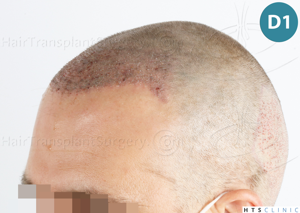 Dr.Devroye-HTS-Clinic-2007-FUE-NW-IVA-10 Dr.Devroye-HTS-Clinic-2007-FUE-NW-IVA-10