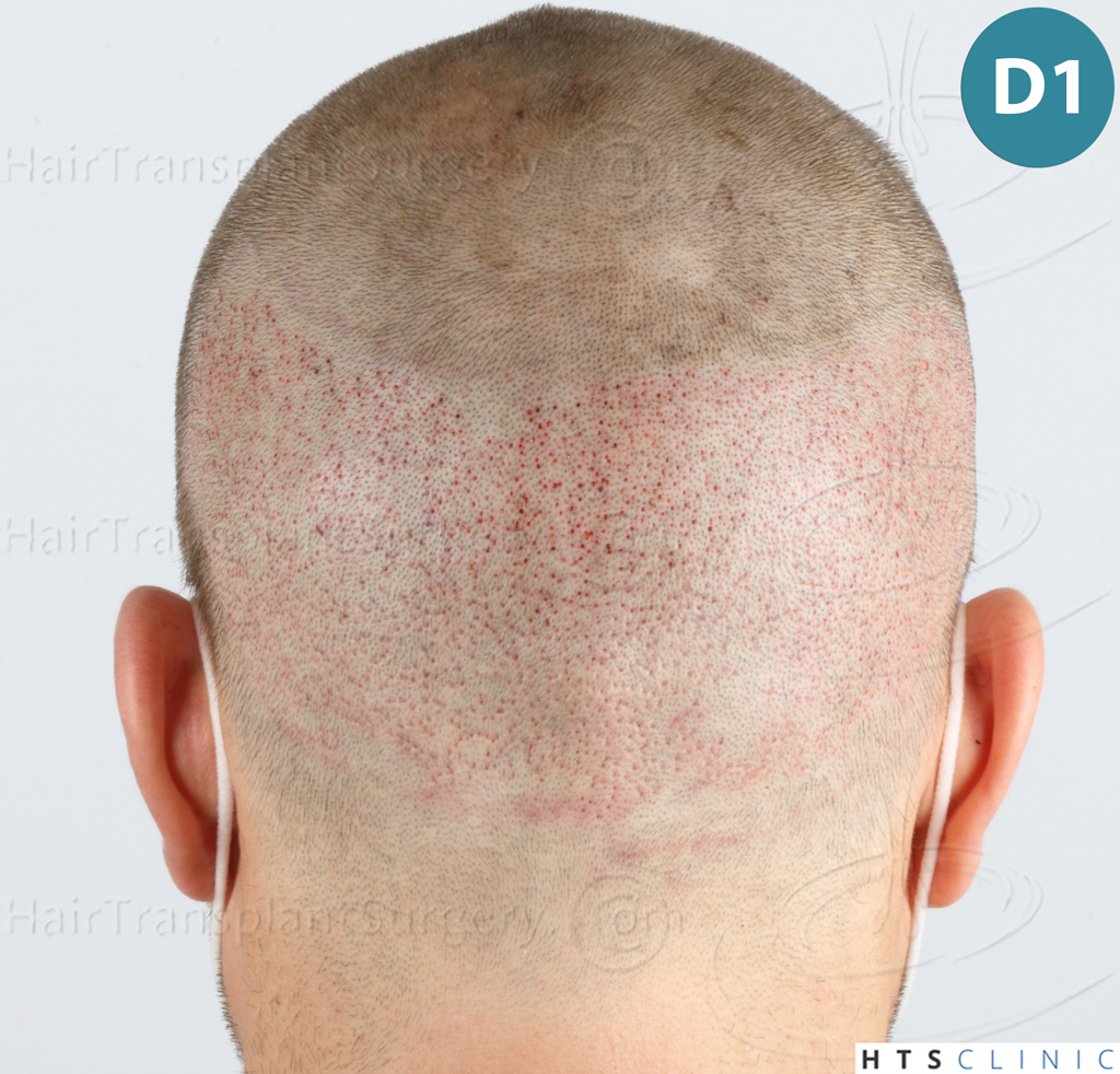 Dr.Devroye-HTS-Clinic-2007-FUE-NW-IVA-12 Dr.Devroye-HTS-Clinic-2007-FUE-NW-IVA-12
