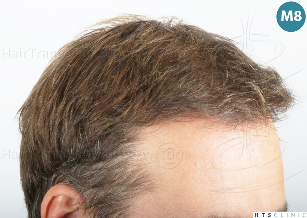 Dr.Devroye-HTS-Clinic-2007-FUE-NW-IVA-20 Dr.Devroye-HTS-Clinic-2007-FUE-NW-IVA-20