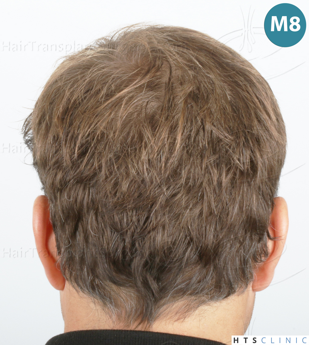 Dr.Devroye-HTS-Clinic-2007-FUE-NW-IVA-21 Dr.Devroye-HTS-Clinic-2007-FUE-NW-IVA-21