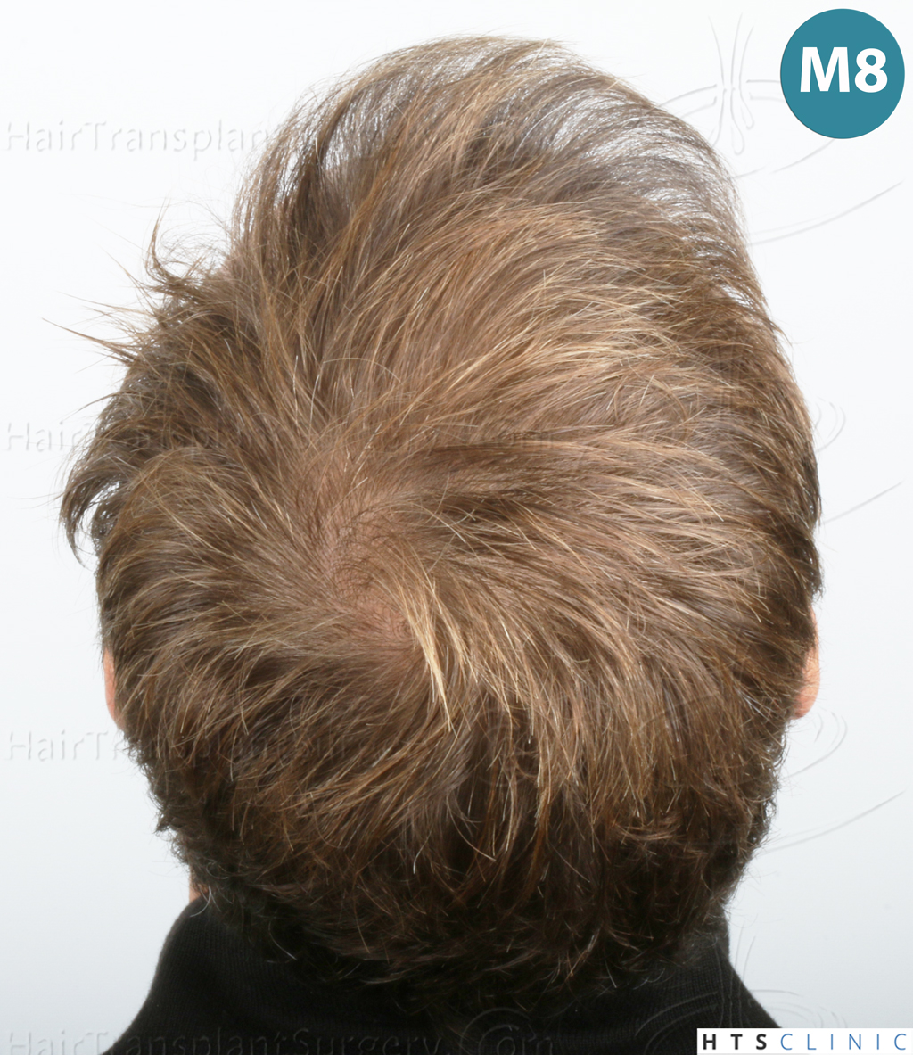 Dr.Devroye-HTS-Clinic-2007-FUE-NW-IVA-22 Dr.Devroye-HTS-Clinic-2007-FUE-NW-IVA-22