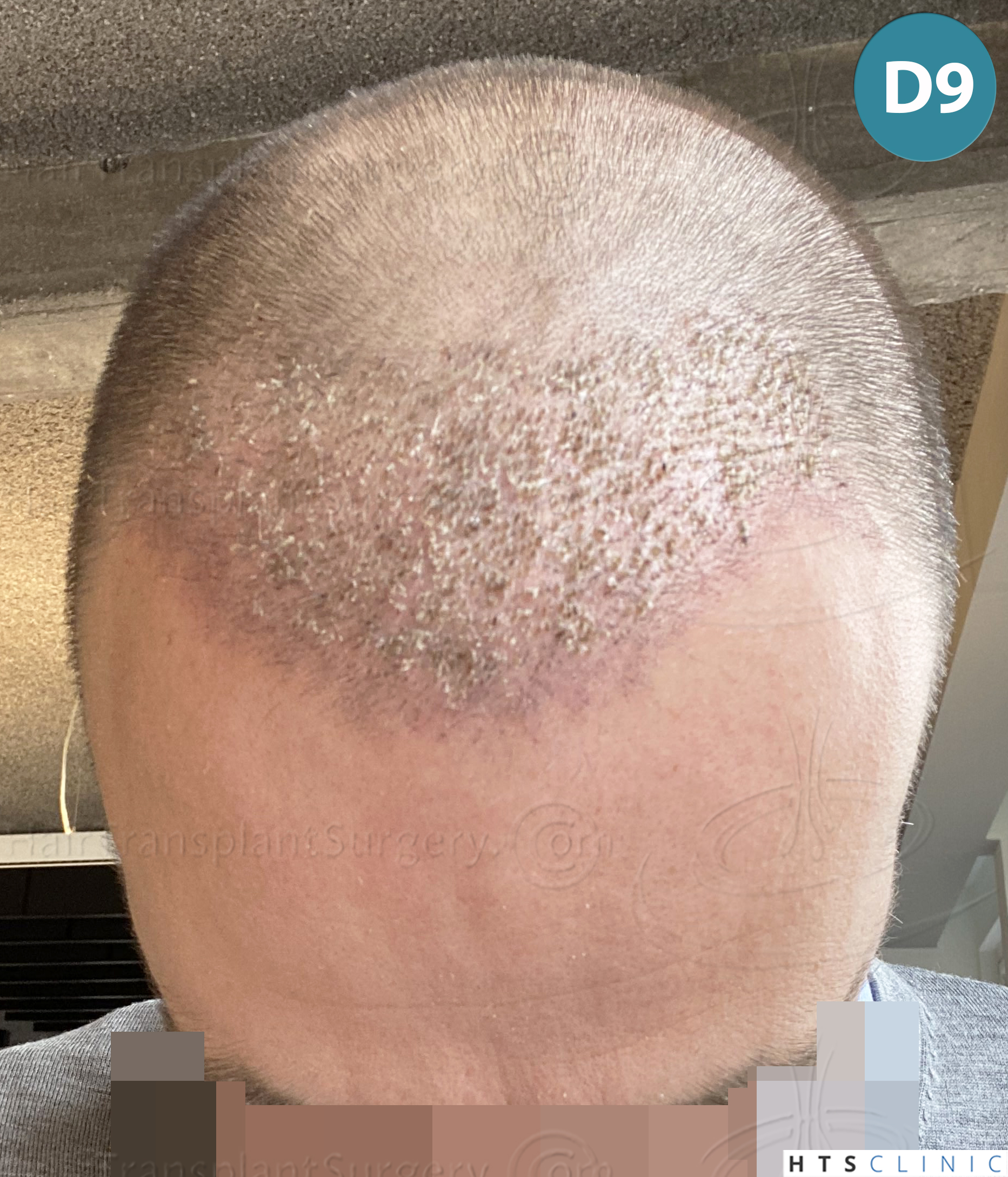 Dr.Devroye-HTS-Clinic-2007-FUE-NW-IVA-13 Dr.Devroye-HTS-Clinic-2007-FUE-NW-IVA-13