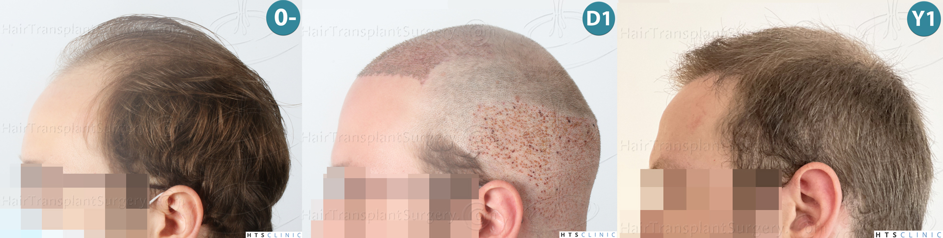 Dr.Devroye-HTS-Clinic-3054-FUE-Montage-4