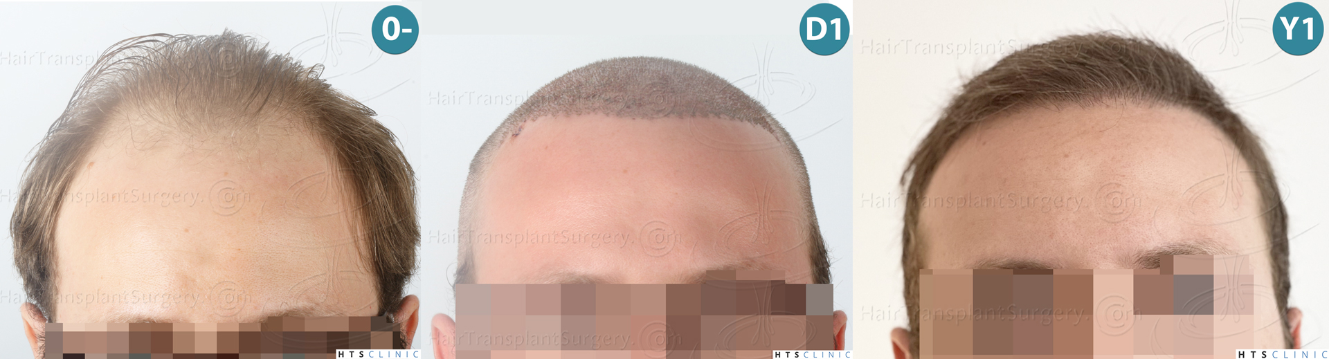 Dr.Devroye-HTS-Clinic-3054-FUE-Montage-1