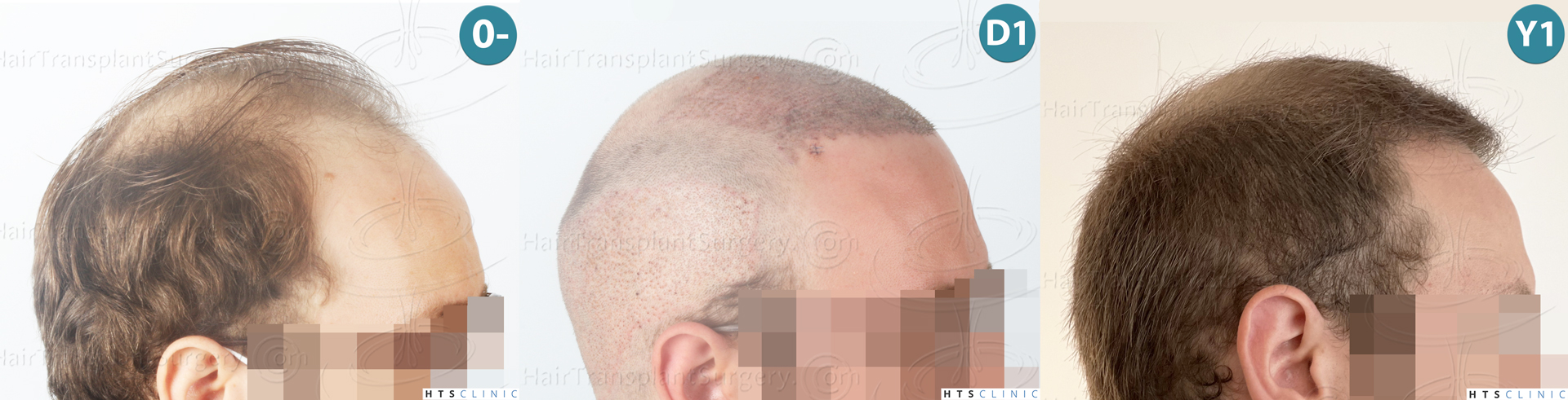 Dr.Devroye-HTS-Clinic-3054-FUE-Montage-5