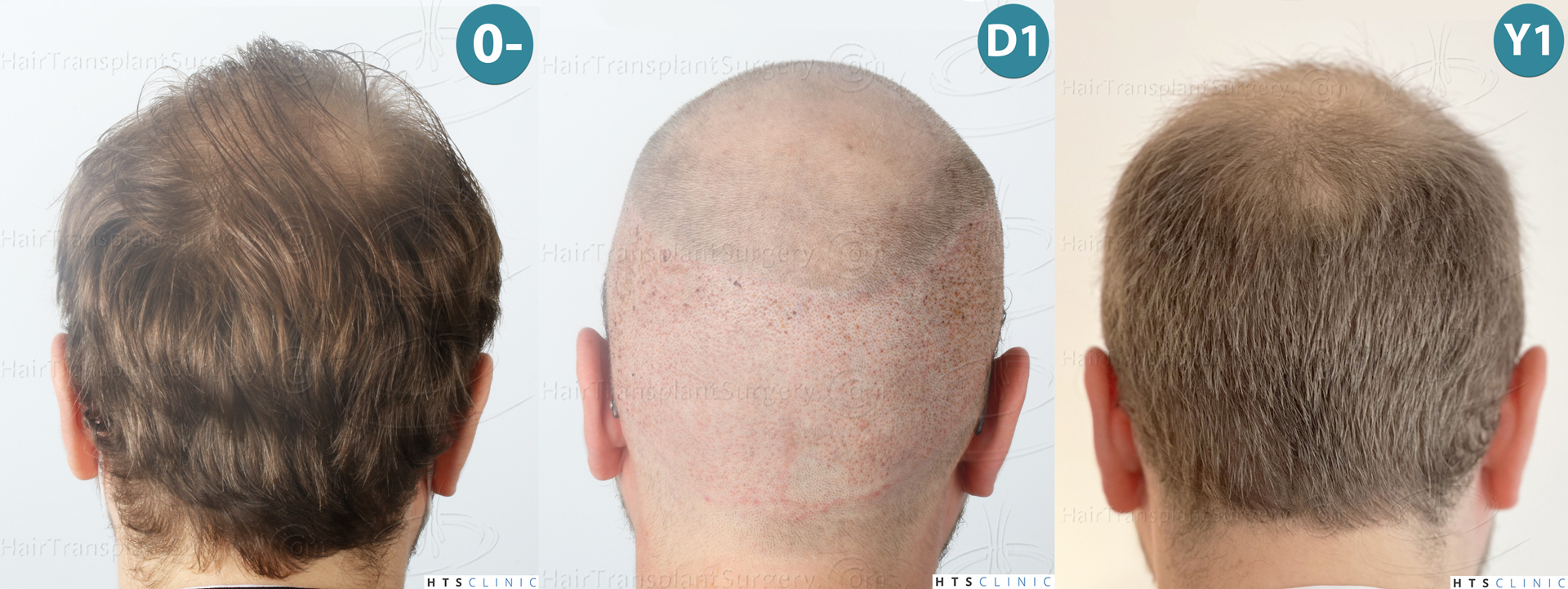 Dr.Devroye-HTS-Clinic-3054-FUE-Montage-6