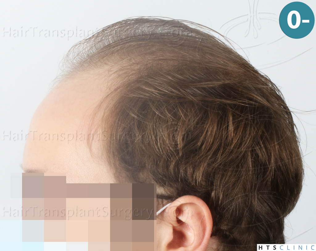 Dr.Devroye-HTS-Clinic-3054-FUE-3