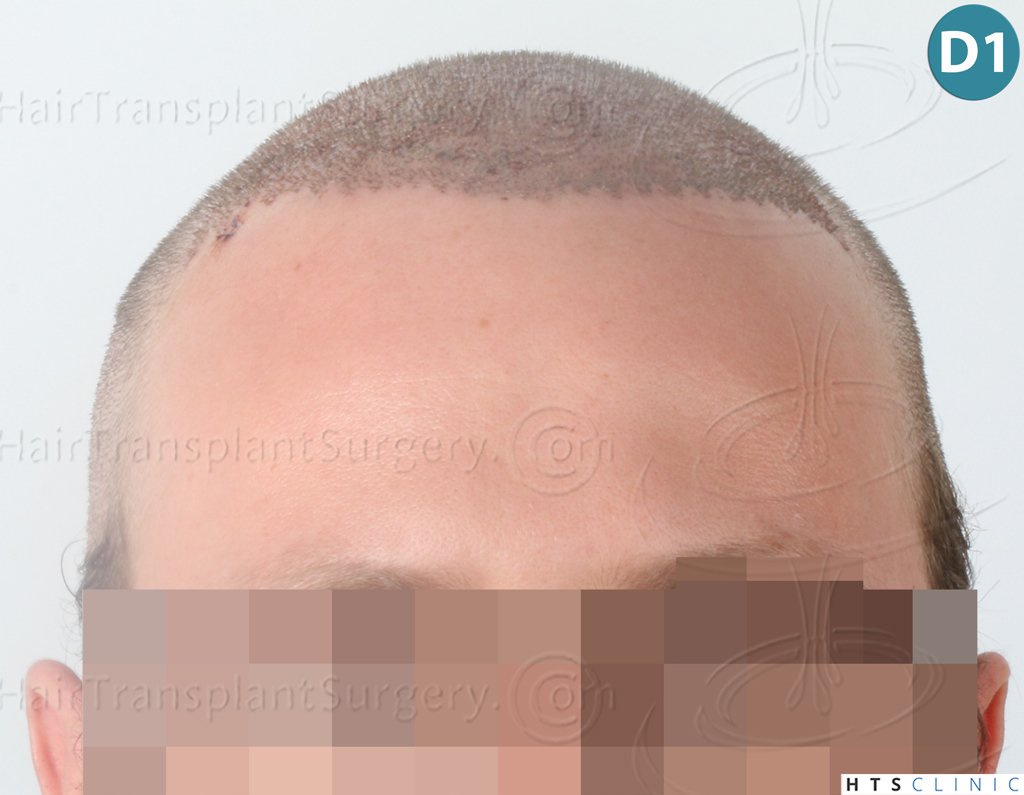 Dr.Devroye-HTS-Clinic-3054-FUE-9