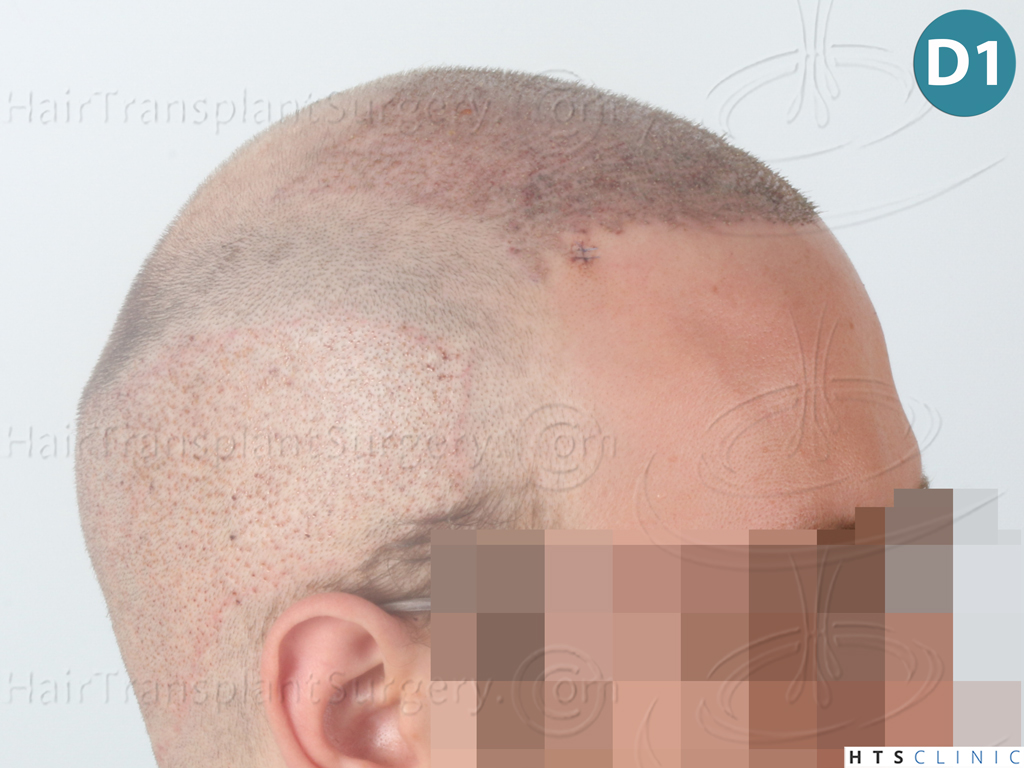 Dr.Devroye-HTS-Clinic-3054-FUE-12