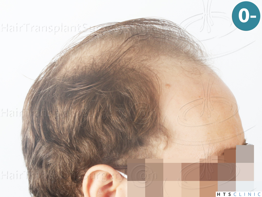 Dr.Devroye-HTS-Clinic-3054-FUE-4