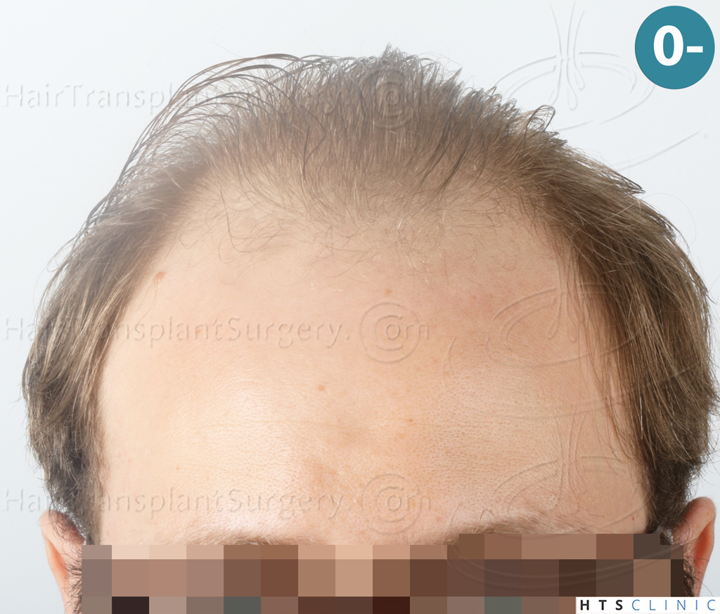 Dr.Devroye-HTS-Clinic-3054-FUE-1